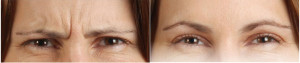 botox2