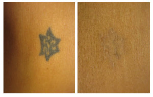 side by side laser tattoo removal
