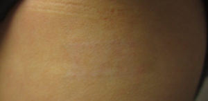 Tattoo after a 1